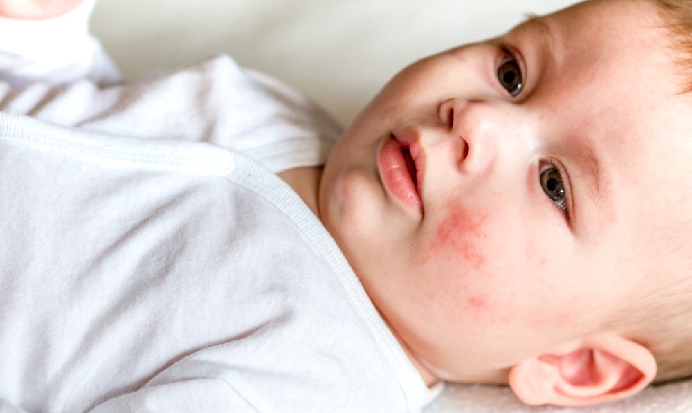 Childhood Eczema: Causes, Symptoms, And Treatment – Womkid