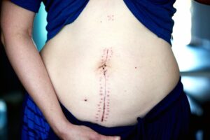 after cesarean